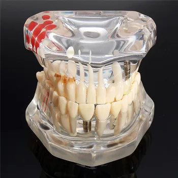 Implantācija, Zobu Slimības, Zobu Modelis Ar Tilta Restaurācija Zobu Zobārsts, Medicīnas Zinātņu Zobu Slimību Studiju Mācību Līdzeklis