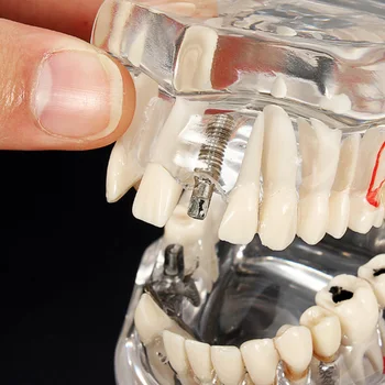 Implantācija, Zobu Slimības, Zobu Modelis Ar Tilta Restaurācija Zobu Zobārsts, Medicīnas Zinātņu Zobu Slimību Studiju Mācību Līdzeklis